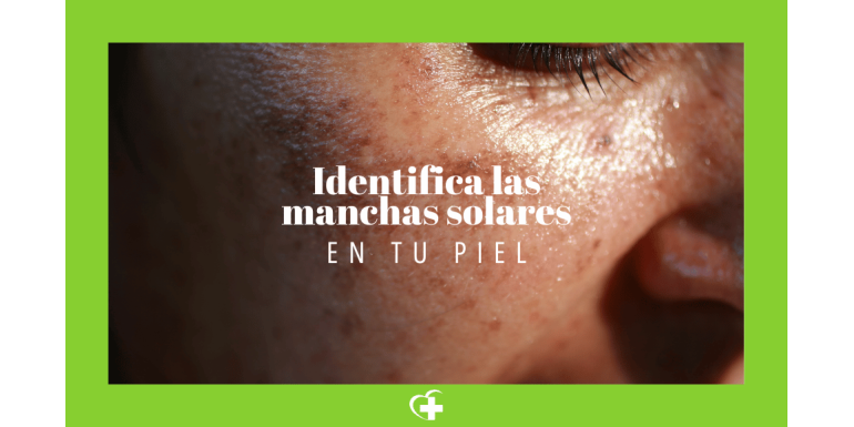 ¿Sabes identificar las manchas de sol en la piel?